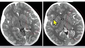 驚！7歲腦炎童大喊：我們都要死掉了