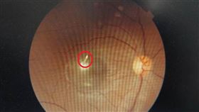 德恩診所眼科主任黃慶瑄表示，一般眼睛常見因異物穿刺眼球，多是從角膜或鞏膜(白眼球)進入，並經過水晶體，造成外傷性的白內障，通常在外觀就可以看到傷口。（圖／大千綜合醫院提供）

