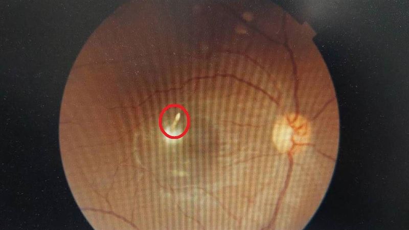 男眼睛模糊看不清　竟有銅線穿刺在內