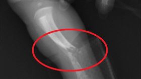 女嬰出生1天骨折，新生兒佝僂病，缺乏維他命Ｄ(圖／中國附醫提供)