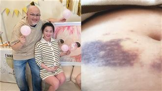 趙小僑為懷孕打針肚瘀青　竟遭酸民嗆