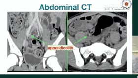 文 MISC闌尾炎1800