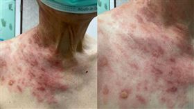 ▲確診引發帶狀皰疹痛爆！脖頸整片紅+水泡（圖／翻攝自黎博彥診所臉書）