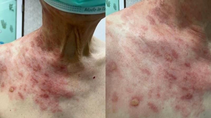 確診脖頸整片紅痛爆！醫：非單純感冒