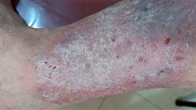 護理師周小姐，本身是重度乾癬病友，包含身體、腿部等都有大面積乾癬。（圖／台灣乾癬協會提供）