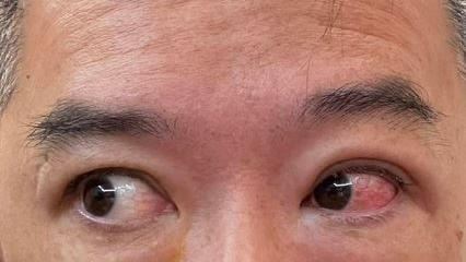 26歲男紫外燈開整晚　起床發現慘了