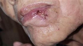 黑痣轉變為潰瘍傷口，長久不癒，擦藥也不見改善。（圖／台北慈濟醫院提供）