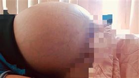 0616卵巢腫瘤(北市聯醫提供)