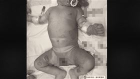  急診醫師翁梓華　特殊型態的家暴—斑馬條紋（Zebra striae） 燙傷　（翁梓華醫師授權提供）