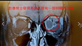 7歲男童，澆花水槍射中左眼，嚴重腫脹，左眼球擠歪，淋巴血管瘤，血腫(圖／彰基醫院提供)