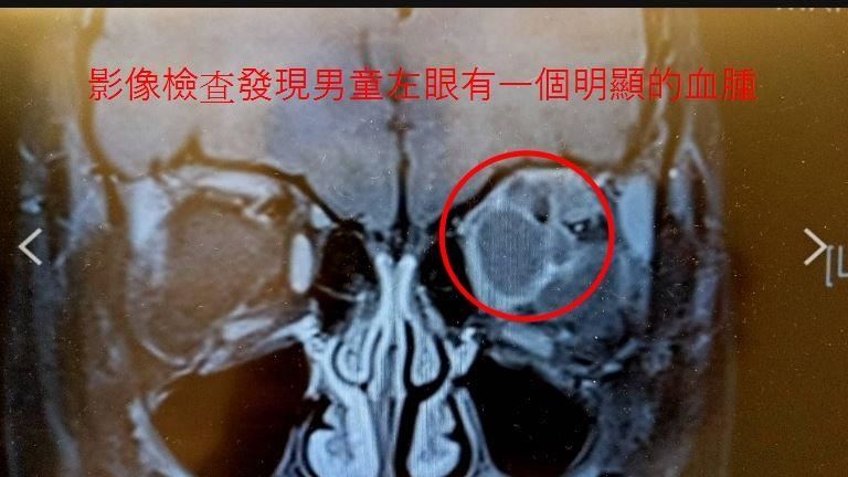 澆花水槍射中　7歲男童左眼球慘擠歪