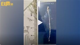 浙江男子在肚子裡發現五公分的豬帶絛蟲（圖／翻攝自白鹿視頻微博）