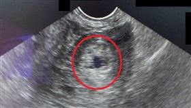 超音波檢查發現陳小姐有3公分大的硬塊(紅圈處)，且合併子宮及腎臟積血。（圖／大千綜合醫院提供）