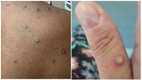 猴痘,翻攝自美國CDC官網https://www.cdc.gov/poxvirus/monkeypox/response/2022/index.html