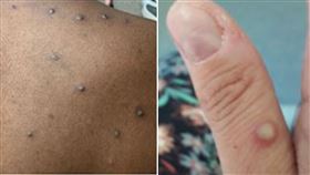 猴痘,翻攝自美國CDC官網https://www.cdc.gov/poxvirus/monkeypox/response/2022/index.html