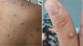 瑞典現較危險M痘病毒株案例　非洲外首見