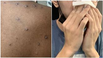 本土+12這縣市最多　猴痘高原期症狀曝光