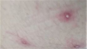 台南,猴痘,照片,大腿,痘痘（台南市衛生局提供）