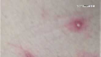 潛伏期14天！女醫手繪圖解猴痘病程