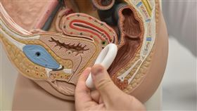 子宮托使用示意圖。子宮托功能即是放在陰道內托住並支撐子宮，避免子宮因肌肉結締組織鬆弛而從陰道掉出。（圖／恩主公醫院提供）