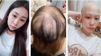 打莫德納疫苗頭髮掉光　正妹心痛曬照