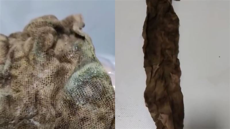 紗布忘產婦體內！醫：不是醫院求妳生