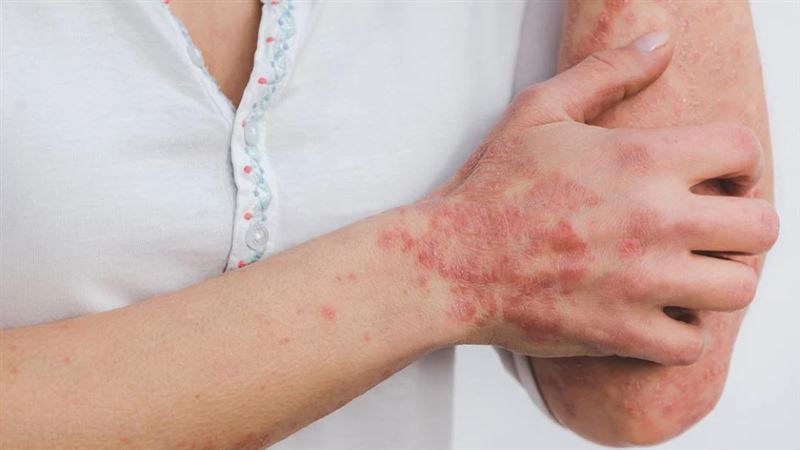 研究證實了！乾癬患者大腸癌風險更高