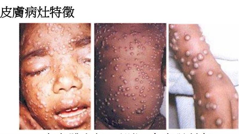 噁！疫苗起源竟「牛痘膿皰液注男童」