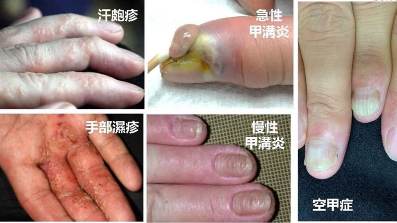 懶人包／皮膚、指甲病了？和疫情有關