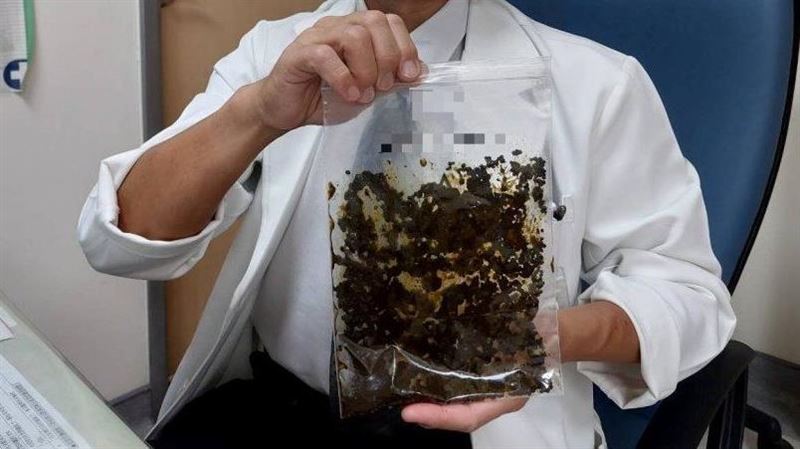 上腹痛就醫　膽囊內竟塞滿2千顆結石