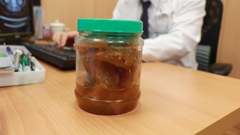 婦罹癌切2/3胃！醫聽「習慣」搖頭
