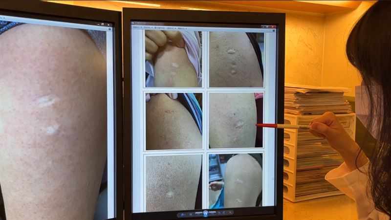 43歲以上手臂有牛痘疤？非無敵星星