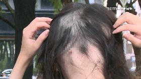 妙齡女掉髮1200