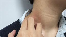 營養午餐吃到鳳梨蝦球　13歲童突呼吸困難、失去意識…（圖／翻攝自奇美醫院網站）