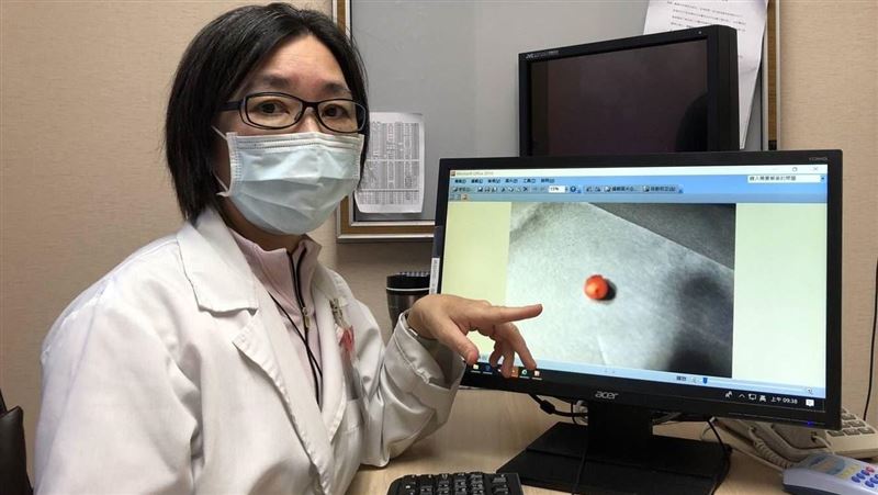 撞到手腫沒理它　2年竟變彈珠神經瘤