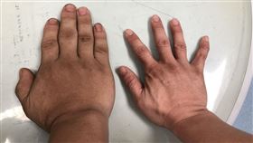 大里仁愛醫院,林文玉,腦瘤,失明,楊孟寅,肢端肥大症