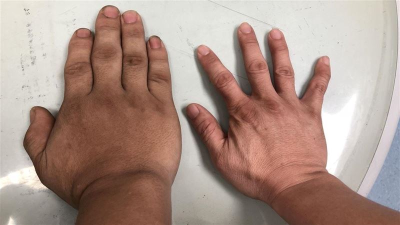 變臉？熟男五官變大！「這疾病」作怪