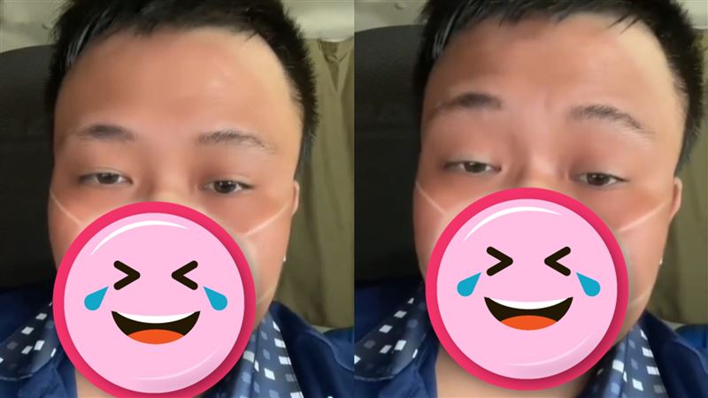 男在台東曬一整天　臉被「芭比Q了」