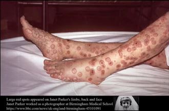 猴痘來勢洶洶！預防猴痘營養師教你這樣吃