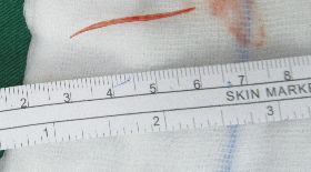 男子魚刺穿出胃部造成膽囊發炎