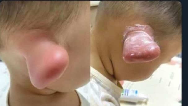 童耳朵遭蟲咬腫成史瑞克　醫驚吐危機