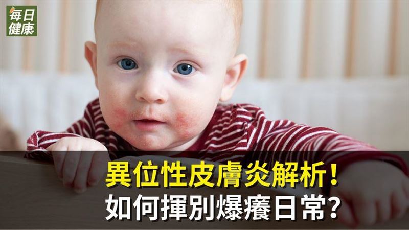 如何揮別爆癢日常？異位性皮膚炎解析