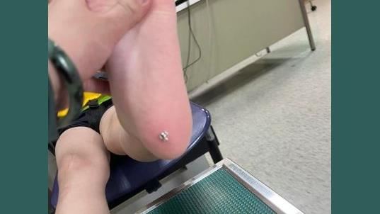 兒玩水遭「耳針扎腳底」　恐怖畫面曝