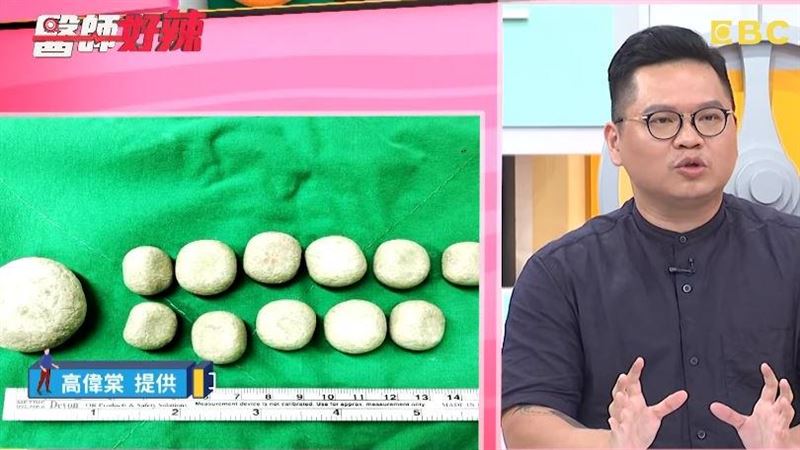 膀胱卡12顆巨石　醫切開赫見大魔王