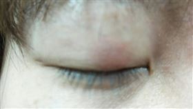 童綜合醫院眼科主任陳沛仁提醒，預防長針眼，除了保持正常作息外，也要清淡飲食。（圖／童綜合醫院提供）