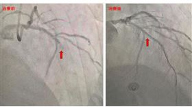 腦中風,心肌梗塞,手術（圖／新竹台大分院提供）