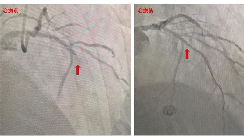 7旬翁嗆咳暈厥　1次竟2大魔王上身