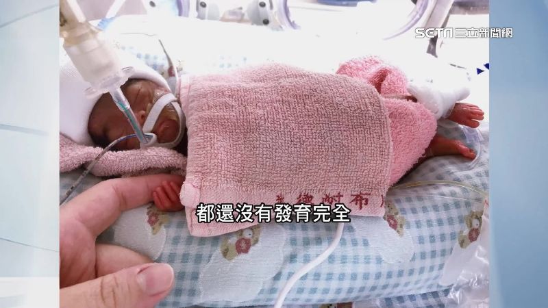21週早產兒　台成功搶救創世界紀錄
