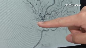 獨／女童一哭就軟腳　醫：毛毛樣病變