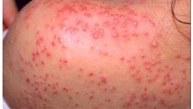 異位性皮膚炎患者病況。（圖／翻攝自朱家瑜醫師簡報）